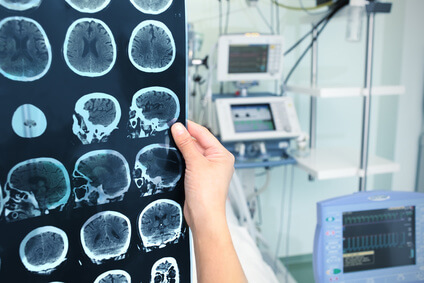 Лечение аневризмы артерий головного мозга в клиниках Израиля
