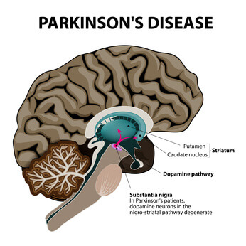 Лечение болезни Паркинсона в клиниках Израиля